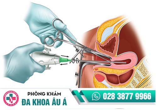 Phương pháp nạo hút thai 