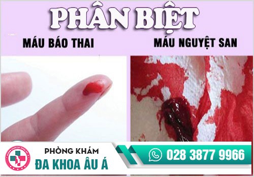 PHÂN BIỆT MÁU BÁO THAI VÀ MÁU NGUYỆT SAN